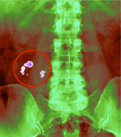 Kidney Stone Imaging