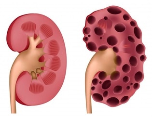 Kidney with Polycystic Disease