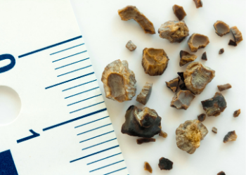 Kidney Stones