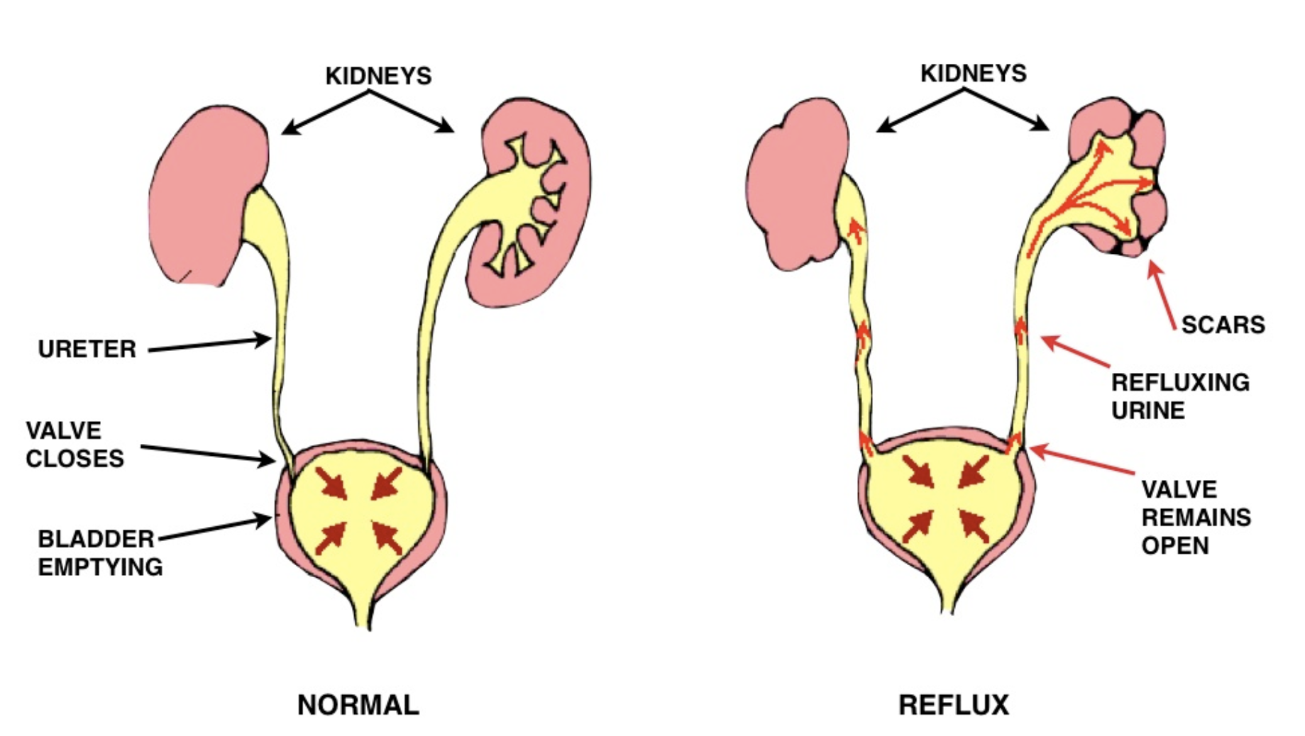 Reflux